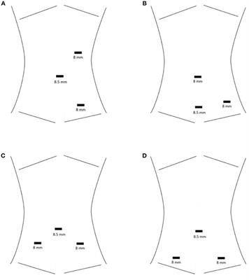 Robotic Ureteral Reconstruction in the Pediatric Population